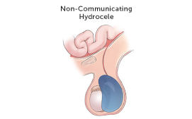 Non-communicating hydrocele