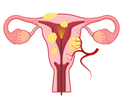 know-more-about-polypectomy-treatment-in-Gurgaon