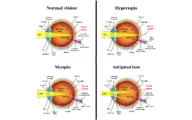 Astigmatism 