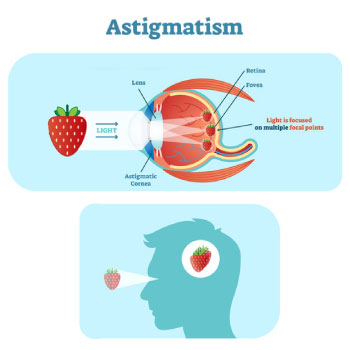 Severity of Astigmatism
