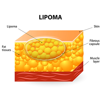 Lipoma - Treatment Types, Causes, Symptoms, Diagnosis, Risk &amp; Recovery ...