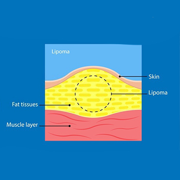 Lipoma - Treatment Types, Causes, Symptoms, Diagnosis, Risk &amp; Recovery ...