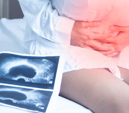 Formation of Ovarian Cysts