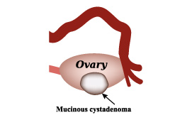 Cystadenomas