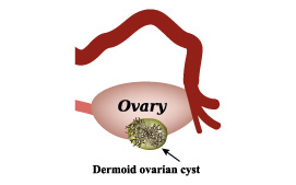 Dermoid Cyst