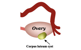 Corpus luteum cysts