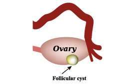 Follicle cysts  