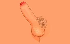Pathologic phimosis type