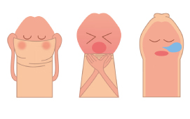 Physiologic phimosis type