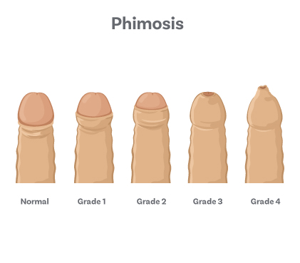 Phimosis