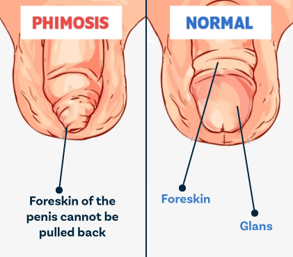 formation of Phimosis