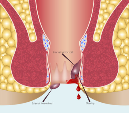 Piles Formation