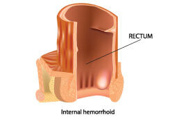 Internal piles