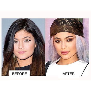 Famous People With Rhinoplasty Hemorrhoids