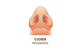 Closed Rhinoplasty 