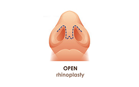 Open Rhinoplasty 