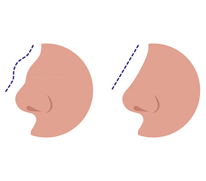 Rhinoplasty