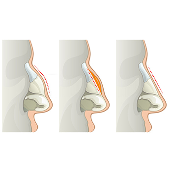 Rhinoplasty formation