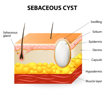 Sebaceous Cyst formation