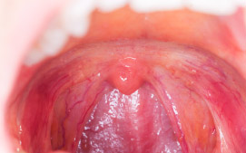 Acute tonsillitis