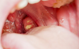 Recurring tonsillitis