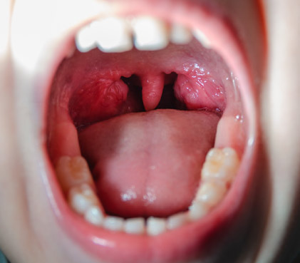 tonsillitis