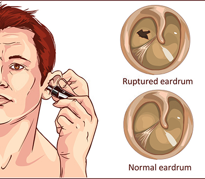 Hole In Eardrum Causes Symptoms Diagnosis Surgery Recovery