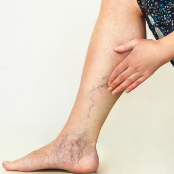Self-diagnosis of Varicose Veins