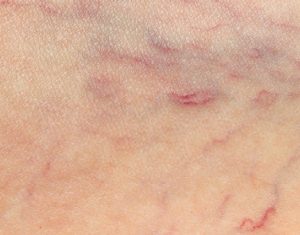 Grade I: (Spider veins)