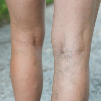 Grade II: (Reticular veins)