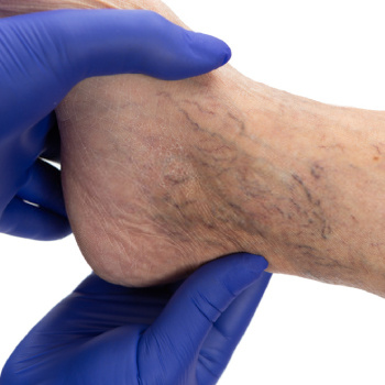 Grade IV: (Chronic venous insufficiency)
