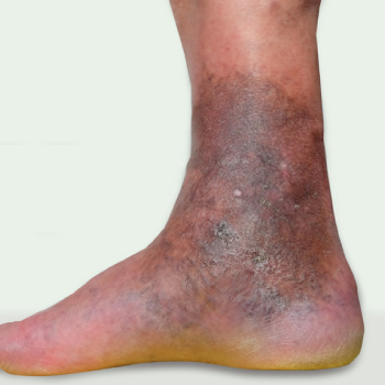 Grade V: (Trophic ulcers or varicose eczema)
