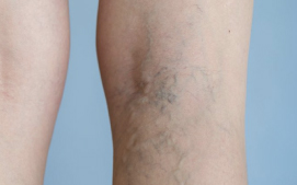 Reticular varicose veins