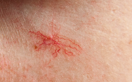 Spider or Thread veins 