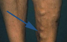 Saphenous/Trunk varicose veins