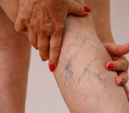 Varicose Veins Treatment