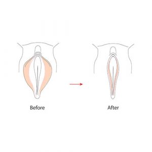 Vagina Shrinking