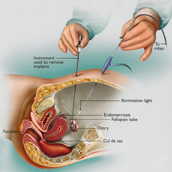 Diagnostic Laparoscopy for Endometriosis 