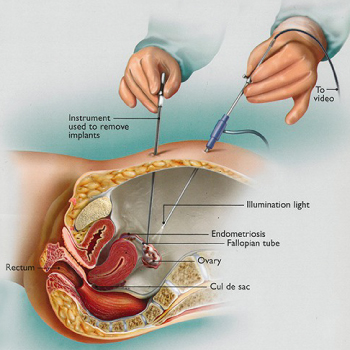 Endometriosis Treatment