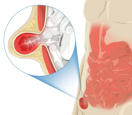 how-does-inguinal-hernia-form