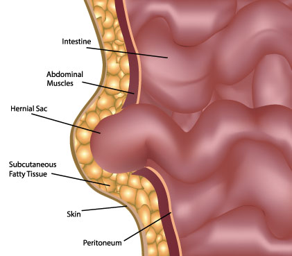 how-does-umbilical-hernia-form