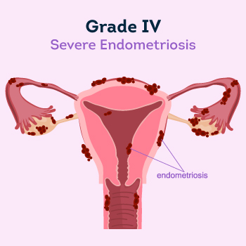 Severe Endometriosis 