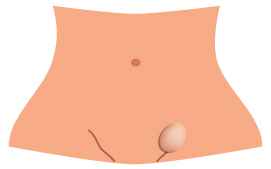 direct-inguinal-hernia