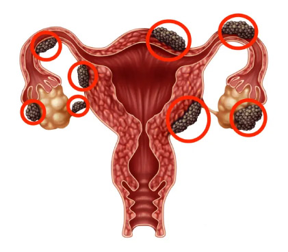Endometriosis 