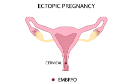 Cervical Ectopic Pregnancy