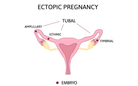 Fallopian Ectopic Pregnancy 