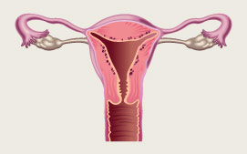 Superficial Adenomyosis