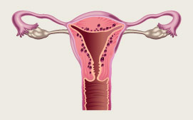 Deep Adenomyosis