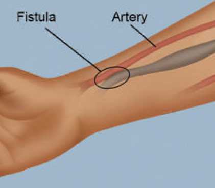 AV Fistula Surgery for Dialysis 