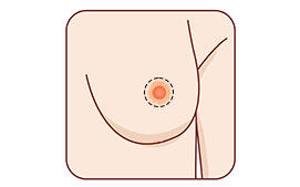 Periareolar or Donut Lift
